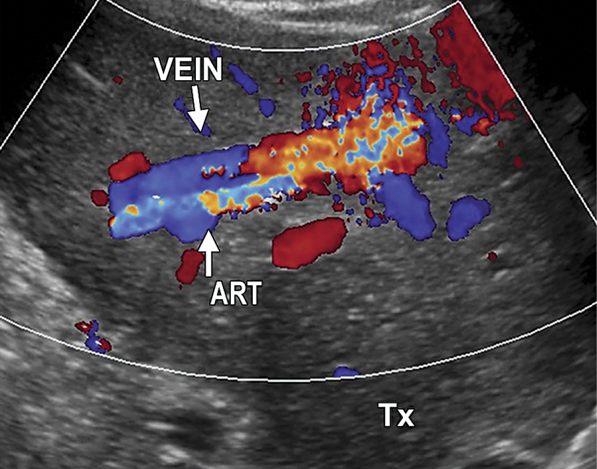 Biopsy-induced AVF in a 6-year-old female recipient of a left-lateral-segment living-donor liver transplant